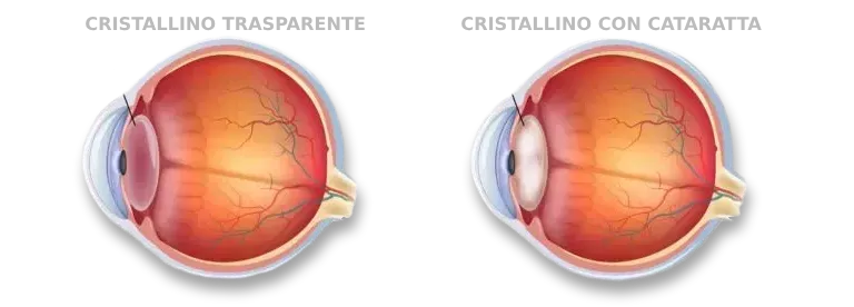 chirurgia-della-cataratta-oculistica-ranno-como-milano-3