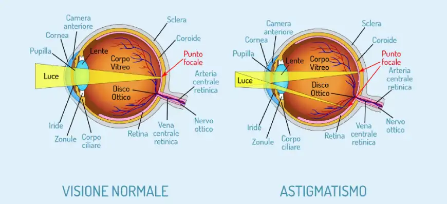 astigmatismo oculistica ranno como milano 02