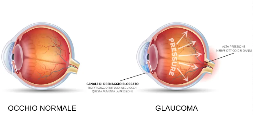 glaucoma-oculistica-ranno-como-milano-02