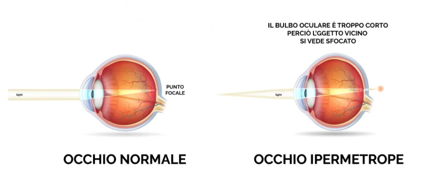 ipermetrofia oculistica ranno como milano 2