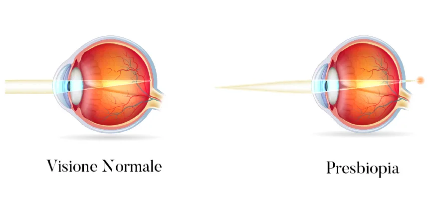 la presbiopia oculista dott stefano ranno como milano 02